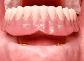 LOCATOR Overdenture
